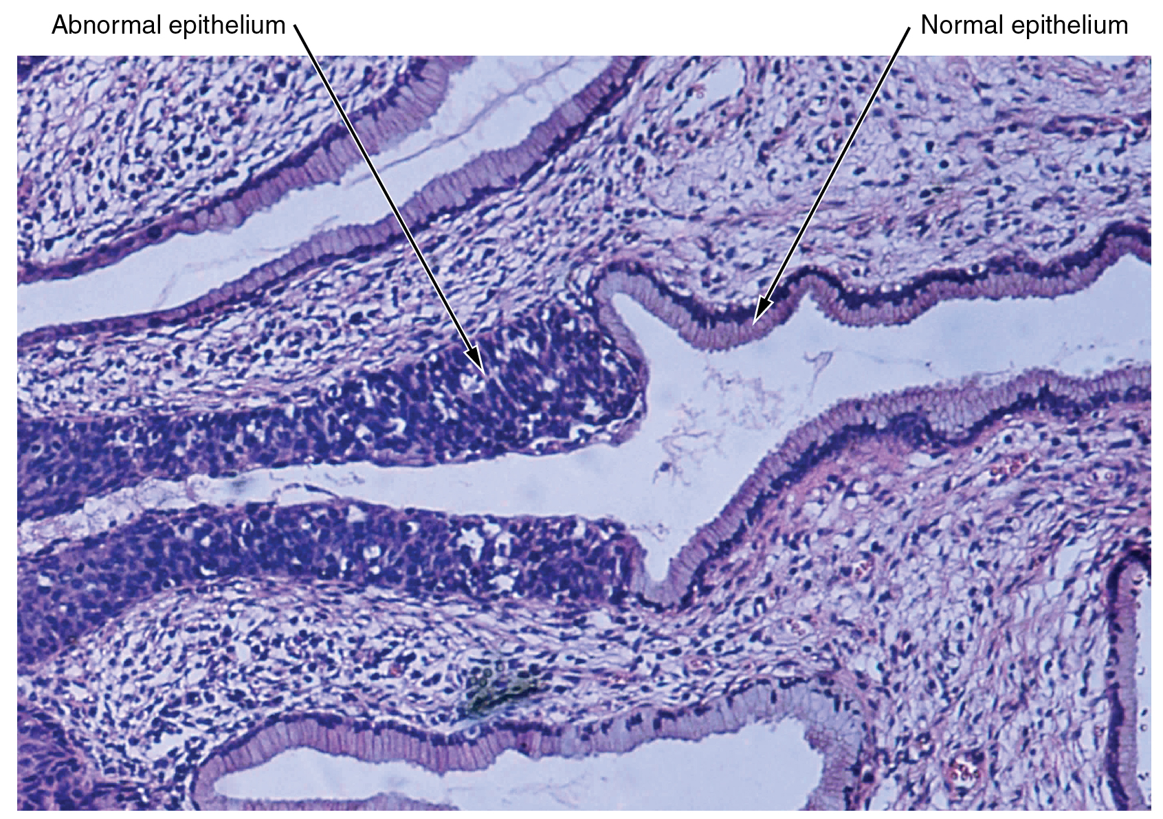 This micrograph shows tissue surrounding several empty spaces. The epithelial tissue occurs at the border between the rest of the tissue and the empty spaces. The normal epithelium is composed of rectangular-shaped cells neatly organized side by side. Dark purple nuclei are clear at the bottom of the epithelial cells, where they attach to the rest of the tissue. The abnormal epithelium appears as a tangled area of purple nuclei, much thicker than the normal epithelium although no distinct cells are discernible.