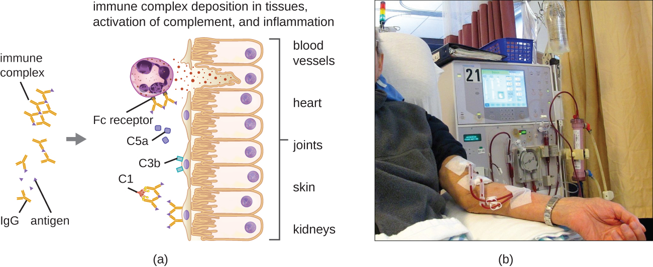 IgG binds to antigens and forms an immune complex made of multiple IgG and antigens. Immune complex deposition in tissues, activation of complement and inflammation. Image shows Immune complex binding to tissues, binding to C1, C3b and C5a binding to tissues. And IgG binding to neutrophils. Tissue damage is shown. B) Person on a dialysis machine.